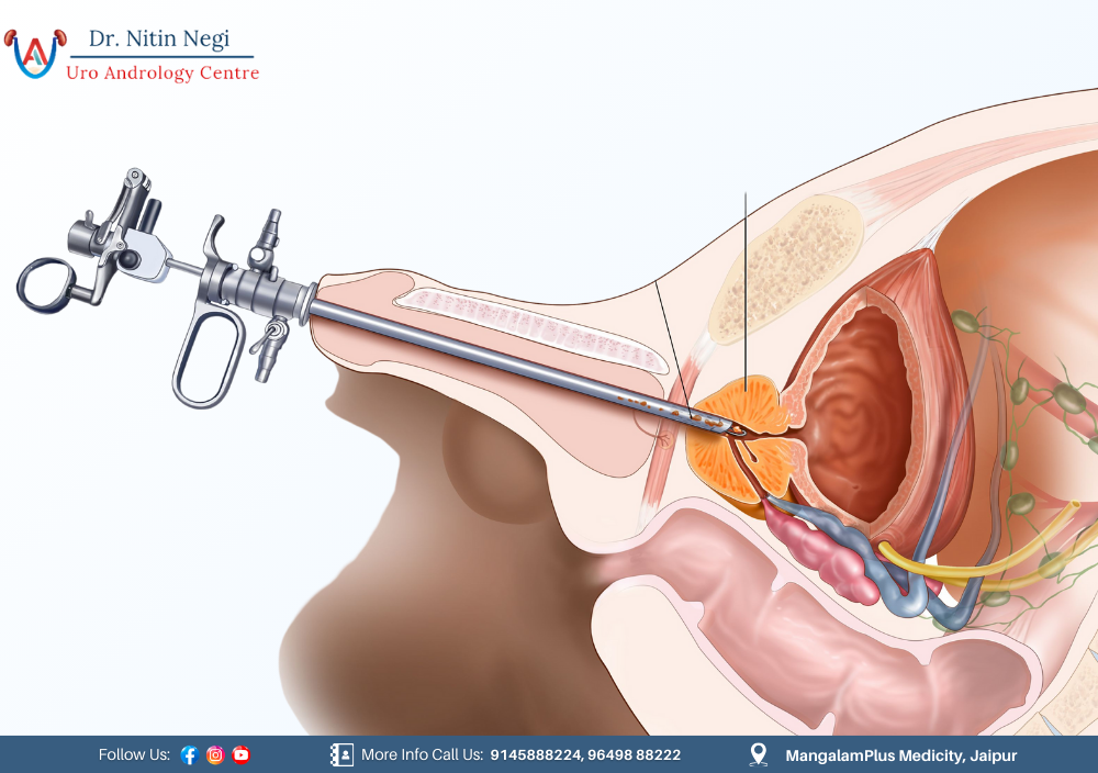 Urologist in japiur