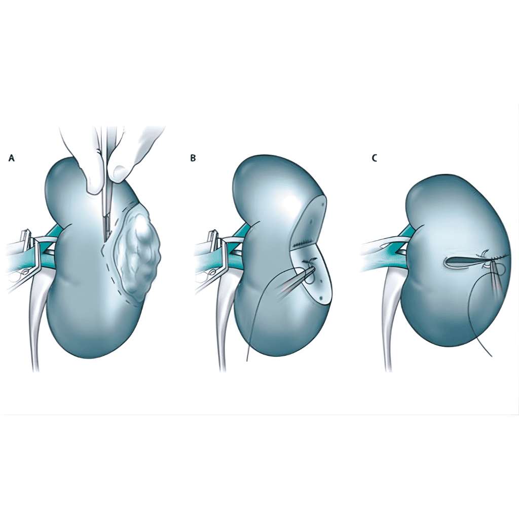 Urology Cancer Surgeries